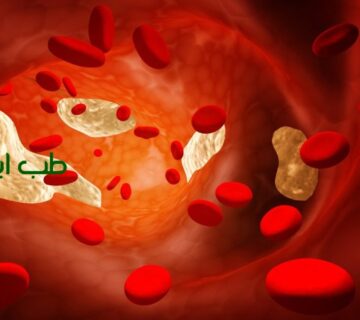 کاهش سریع چربی چربی خون در طب سنتی
