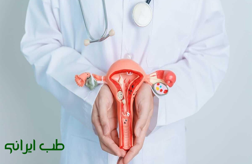 درمان تنبلی تخمدان در طب سنتی