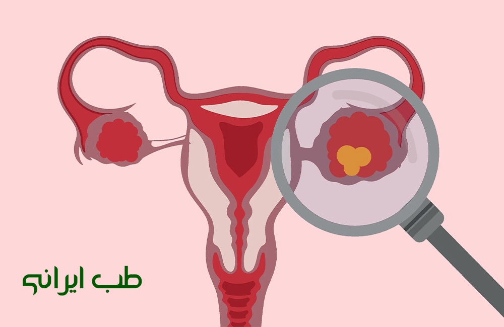 داروی گیاهی برای کیست تخمدان