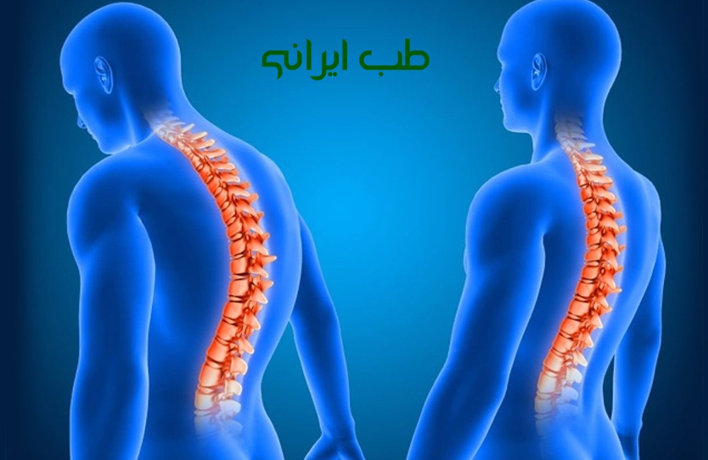 درمان سستی کمر با داروی گیاهی