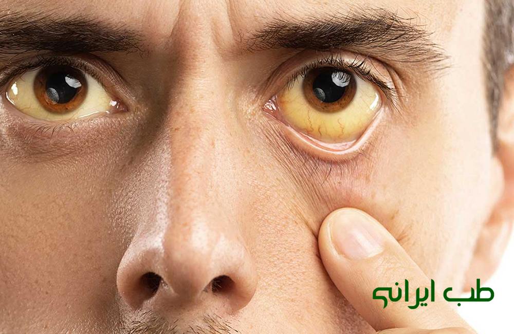 داروهای گیاهی برای زردی زانو