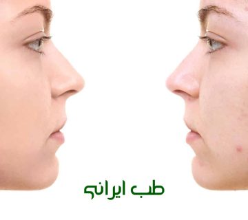 حجامت برای جوش صورت