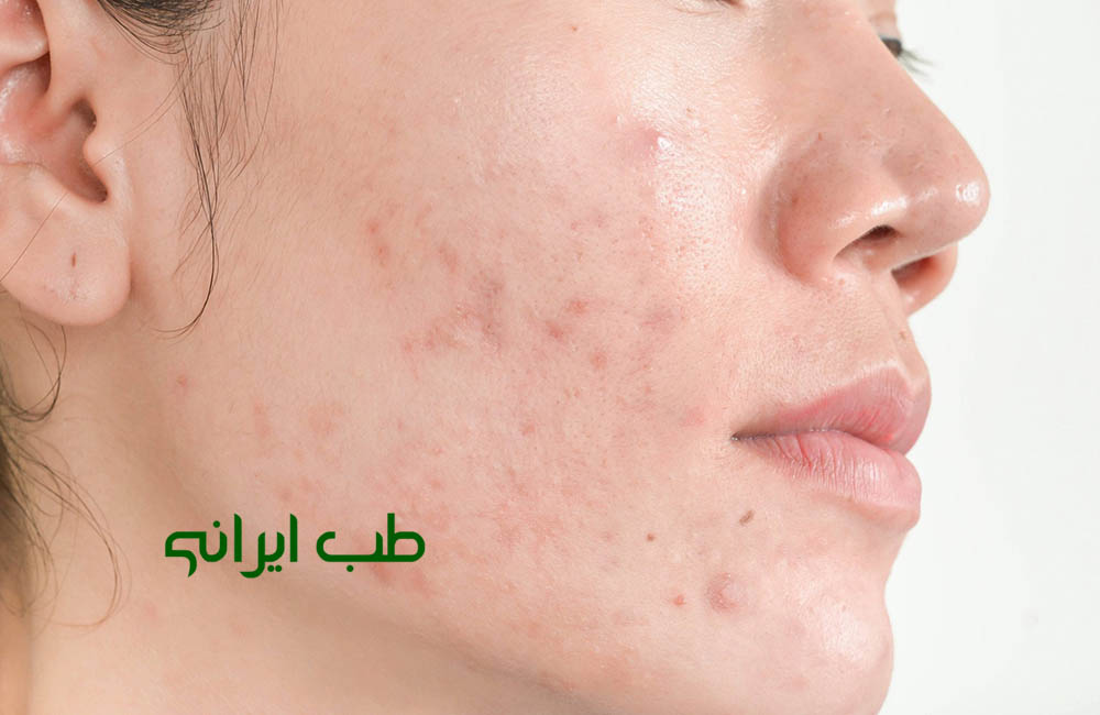 آیا حجامت صورت برای جوش خوب است