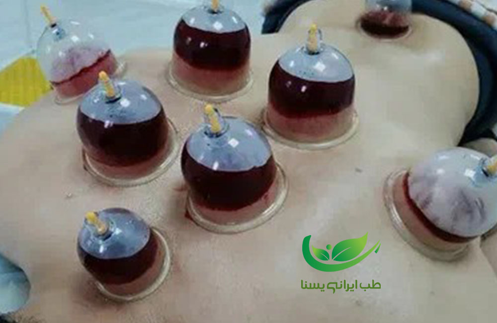حجامت کبد