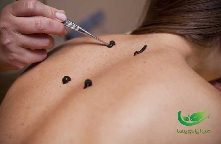 زالو درمانی در درمان پسوزیاریس