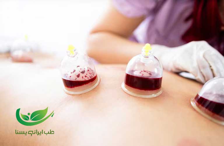 موارد منع انجام حجامت