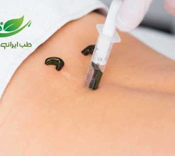 حجامت با زالو یکی از روش های دیرین در طب سنتی است.