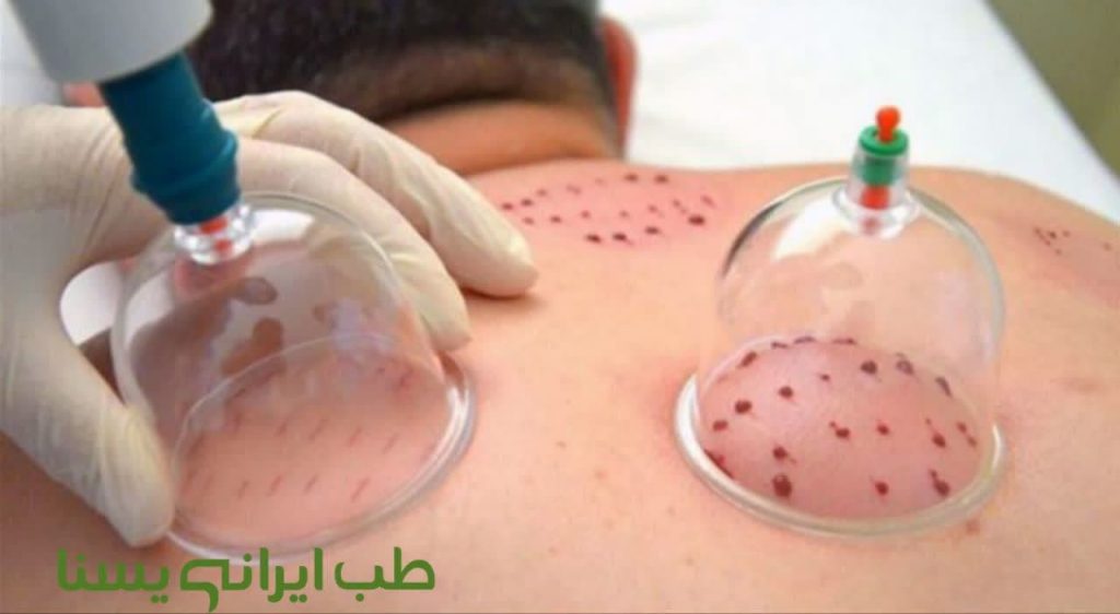 حجامت