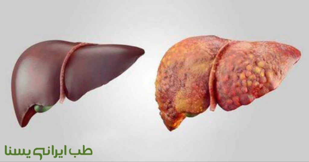 علائم کبد چرب