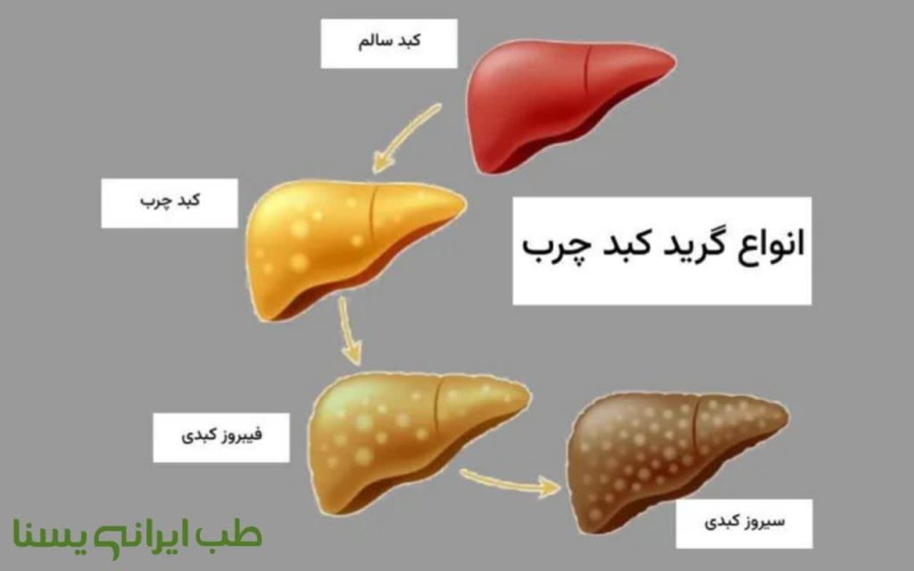 گرید بندی کبد چرب